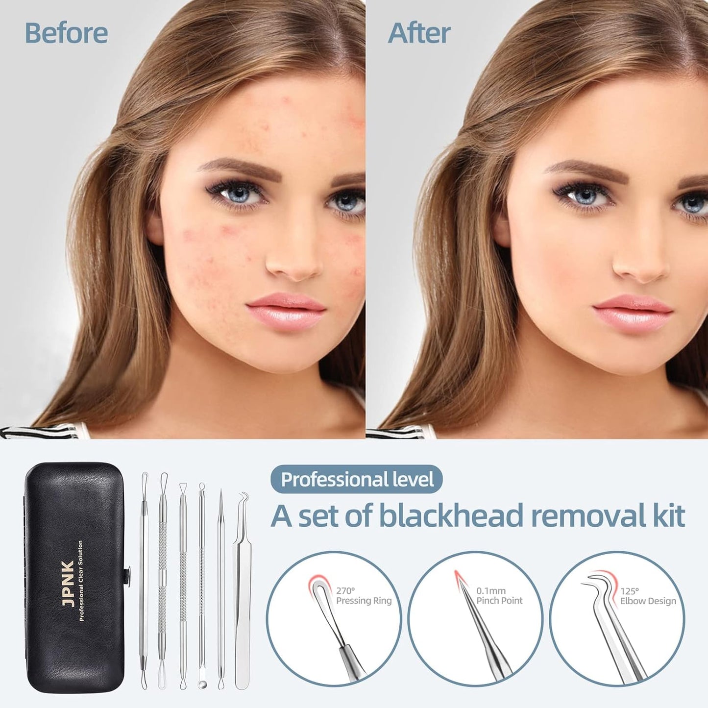 Stainless Steel Blackhead Remover Comedone Extractor Kit
