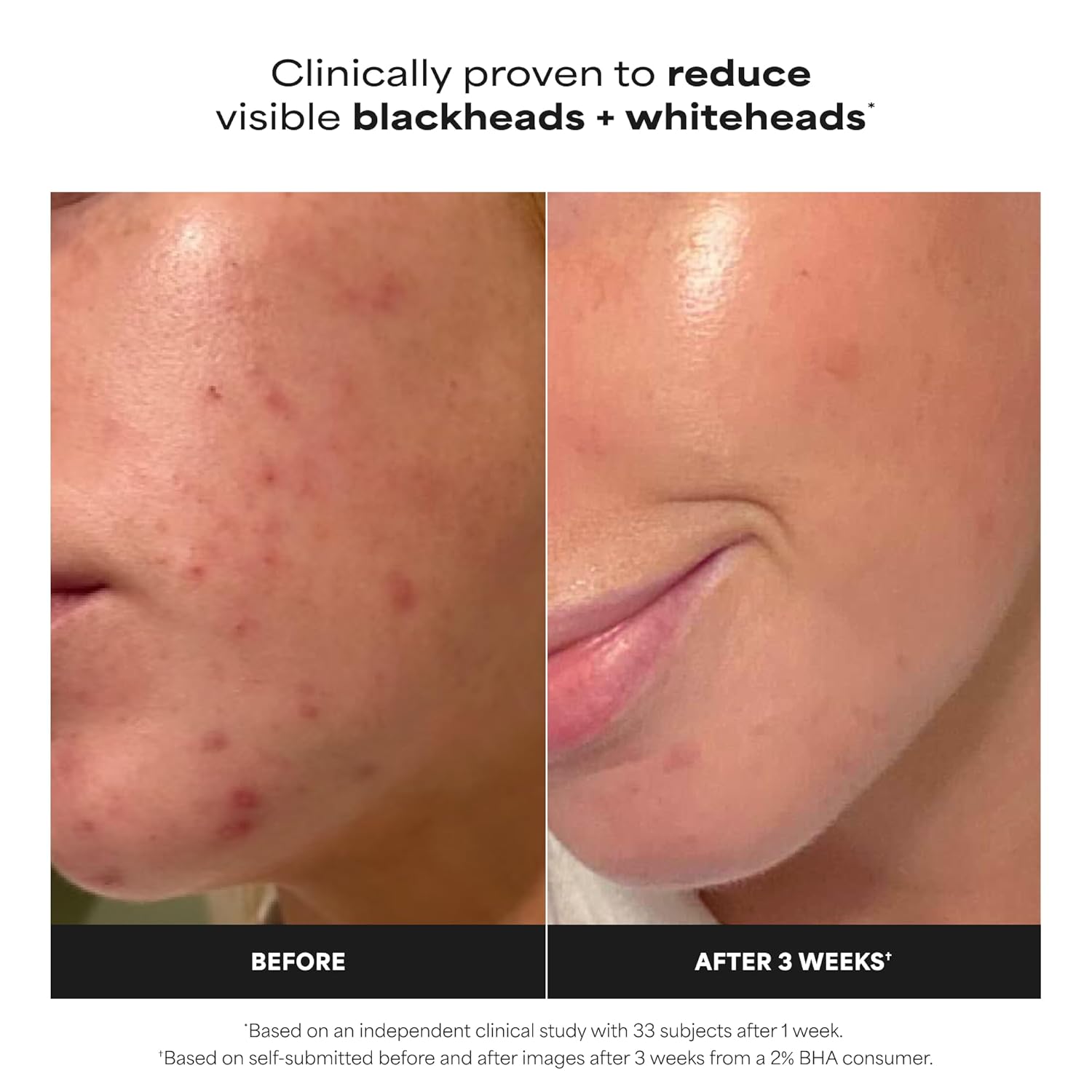 2% BHA Liquid Exfoliant for Clear, Smoother Skin
