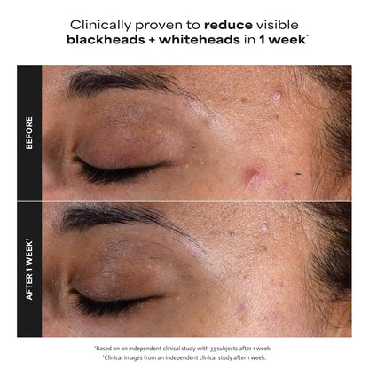 2% BHA Liquid Exfoliant for Clear, Smoother Skin