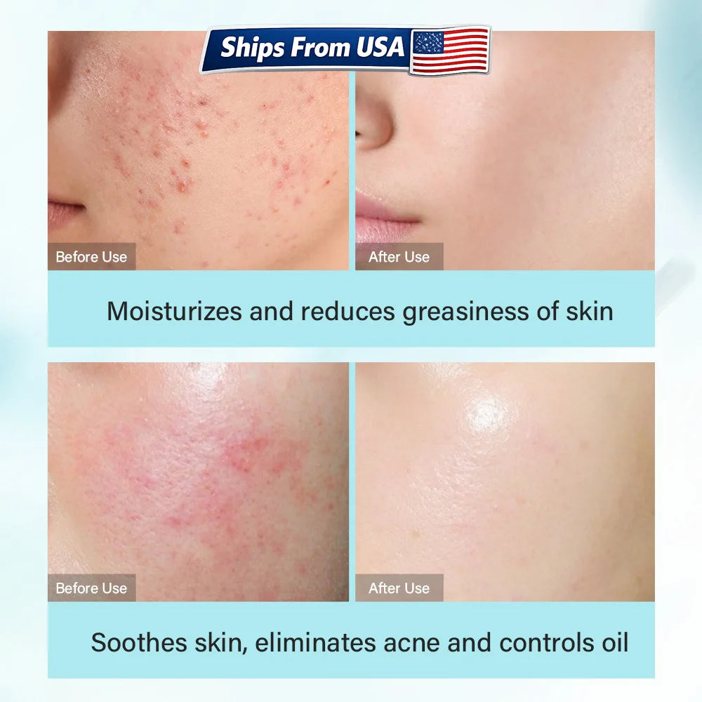 Tea Tree Skincare Set for Women – Oil Control & Acne Care